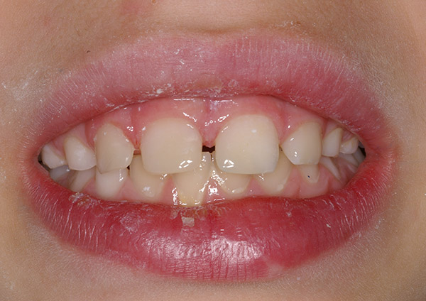After-Dents trencades