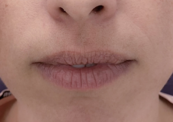 Before-Estètica Facial (Àcid hialuronic/ augment de llavis)
