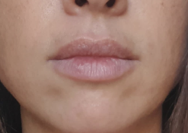 After-Estètica Facial (Àcid hialuronic/ augment de llavis)